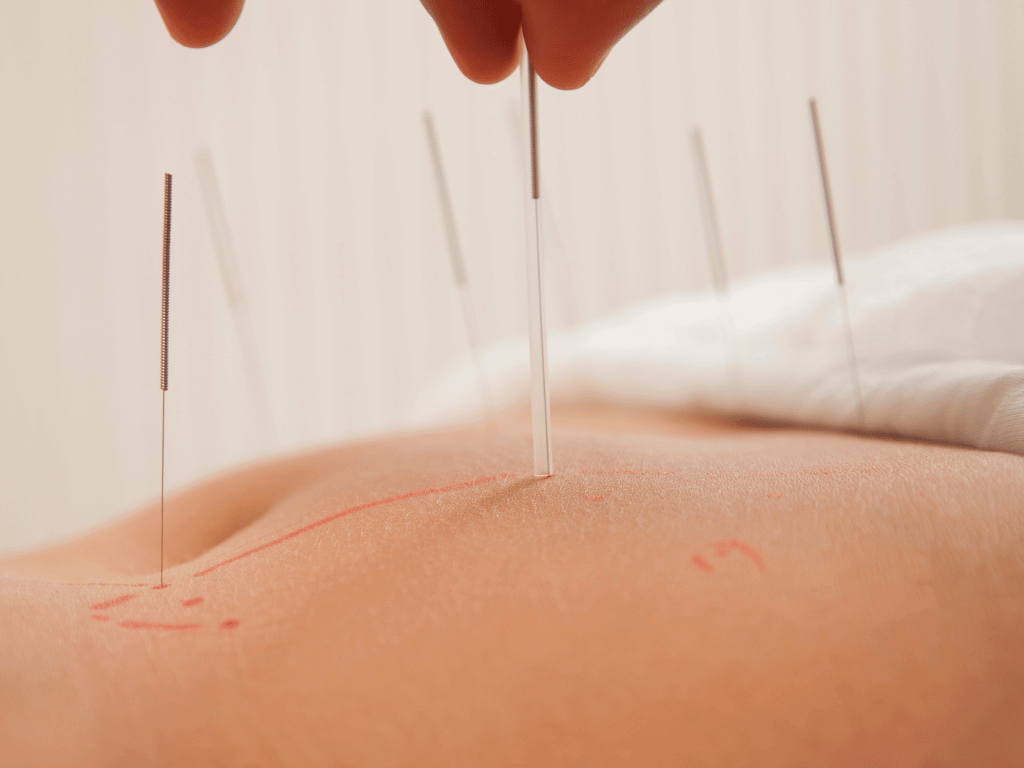 Acupuncture needles inserted into stomach for the purpose of weight loss