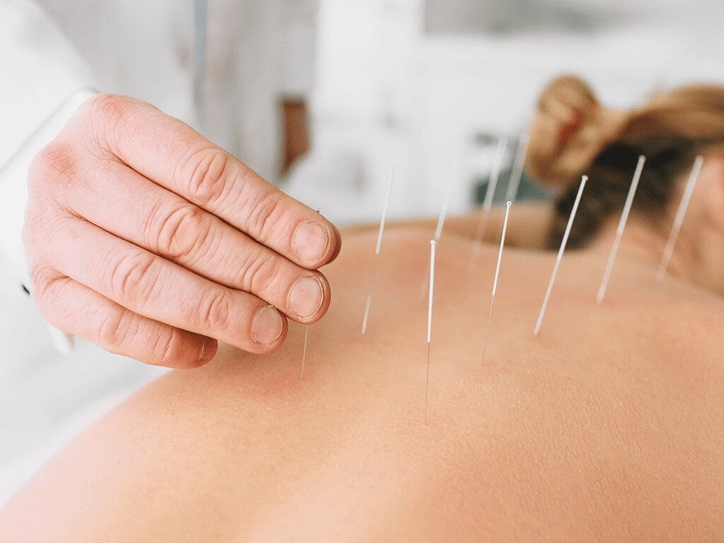 Acupuncturist inserts thin sterile needles into a patient’s back as part of traditional Chinese medicine treatment.
