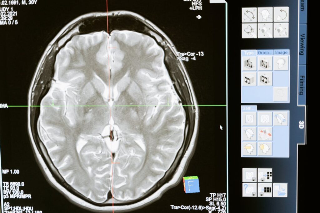 Increased activation in brain regions linked to emotion regulation and stress during hunger states, shown in brain scan.