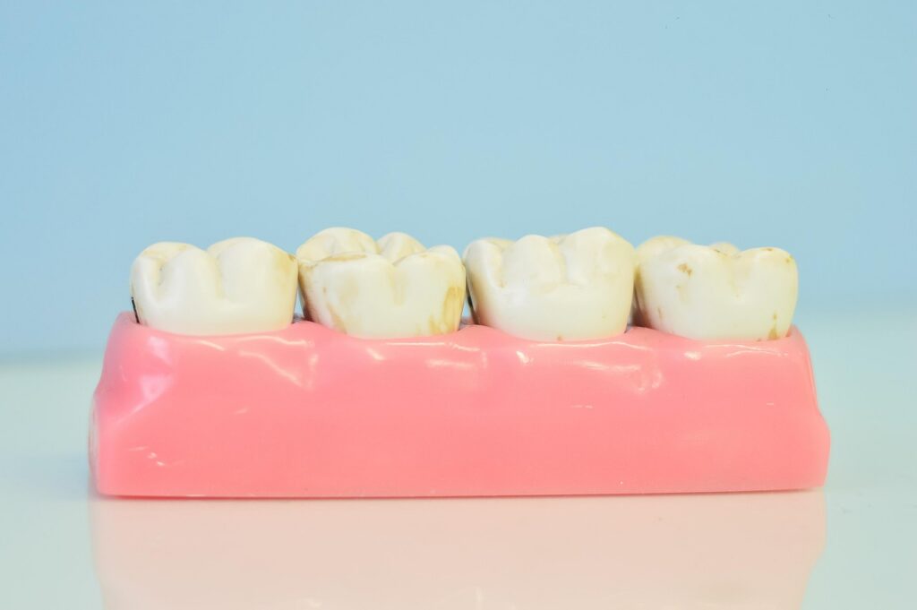 Plastic model of teeth showing worn enamel as acidic drinks like Coke Zero can erode tooth enamel over time.