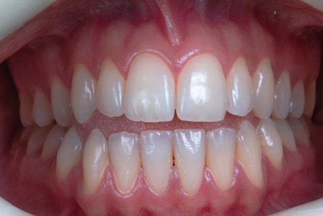Citric acid can gradually erode protective tooth enamel and increase sensitivity when consumed frequently.